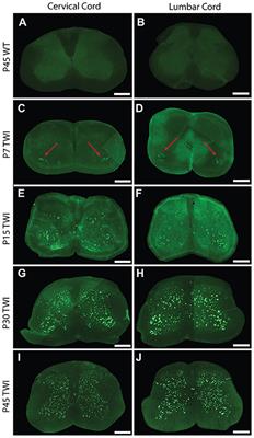 AAV-Mediated GALC Gene Therapy Rescues Alpha-Synucleinopathy in the Spinal Cord of a Leukodystrophic Lysosomal Storage Disease Mouse Model